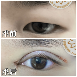 广州禾丽整形医院高超割双眼皮技术好不好？